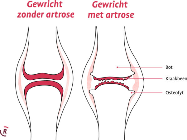 Gewricht met en zonder artrose